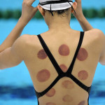 Minder stress en lichamelijke klachten door Cupping