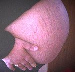 striae door zwangerschap