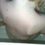 De impact van waterpokken waterpokken