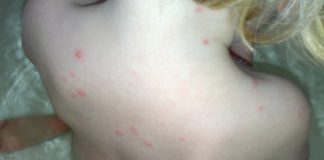 De impact van waterpokken waterpokken