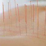 Hoe werkt acupunctuur? acupunctuur