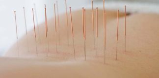 Hoe werkt acupunctuur? acupunctuur