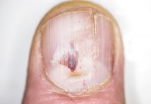 Hoe kom je van kalknagels af? kalknagels