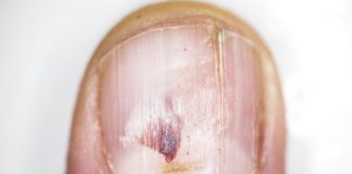 Hoe kom je van kalknagels af? kalknagels