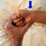 Wat is het syndroom van De Quervain? De Quervain