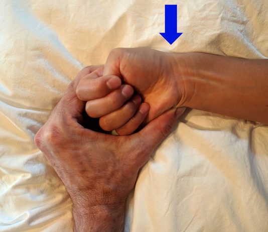 Wat is het syndroom van De Quervain? De Quervain