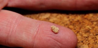 Hoe kun je nierstenen herkennen? nierstenen