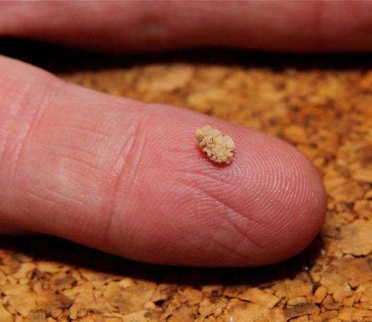 Hoe kun je nierstenen herkennen? nierstenen