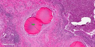 Wat is een vleesboom precies? vleesboom