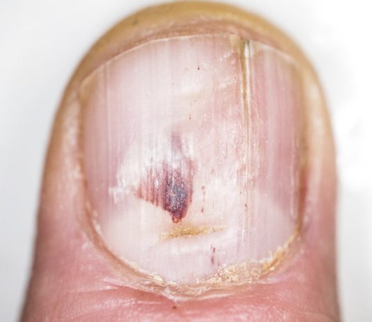 Kalknagels; hoe voorkom je het en hoe kom je er vanaf? kalknagels