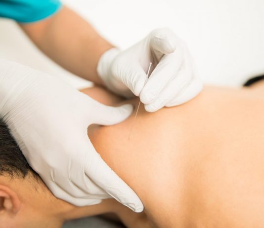 Fysiotherapie in Hilversum bij spierklachten. Wat is Dry needling? dry needling
